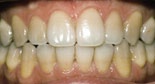 tänder före behandling