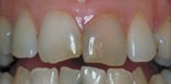 tänder före behandling